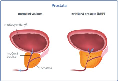 rostata|prostata u kobiet.